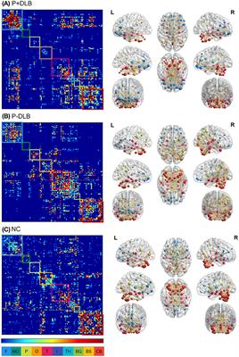 Altered resting state brain metabolic connectivity in dementia with Lewy bodies